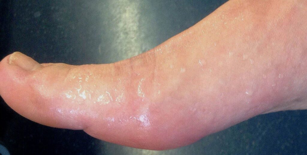 Пітніють ноги: чому так відбувається і що з цим робити