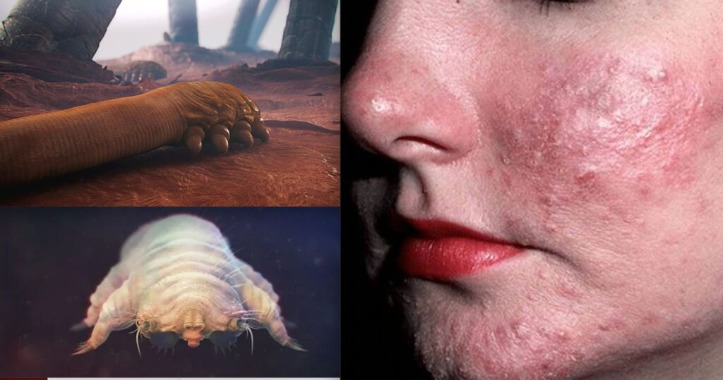 Підшкірний кліщ у людини: що це таке, і як з ним боротися