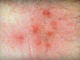 Підшкірний кліщ у людини: що це таке, і як з ним боротися